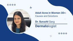 Adult Acne in Women 30+: Causes and Solutions