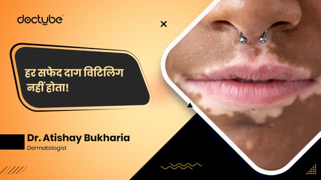 हर सफेद दाग विटिलिगो नहीं होता!