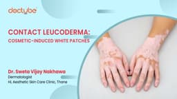 Contact Leucoderma: Cosmetic-Induced White Patches