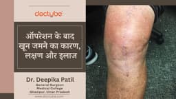 ऑपरेशन के बाद खून जमने का कारण, लक्षण और बचाव