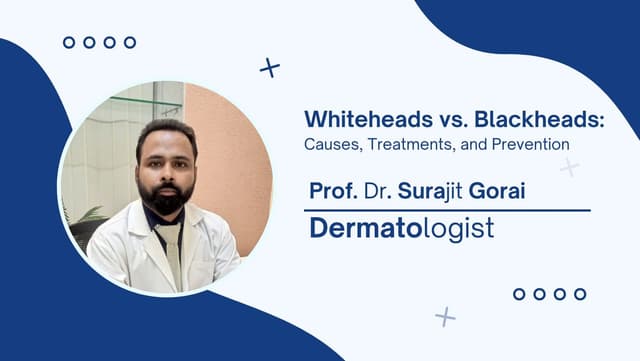 Whiteheads vs. Blackheads: Causes, Treatments, and Prevention