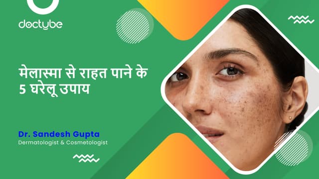 मेलास्मा से राहत पाने के 5 घरेलू उपाय