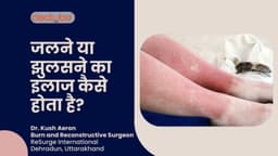 जलने या झुलसने का इलाज कैसे होता है?